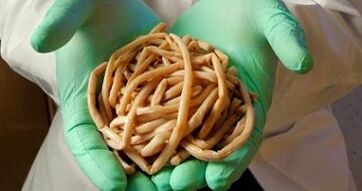 parasites extracted from the human body