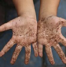 dirty hands as the cause of worms in a child