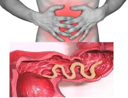 signs of chronic helminthiasis are dyspeptic bowel disorders