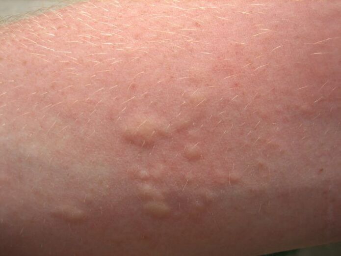 itchy allergic skin rashes may be symptoms of ascariasis