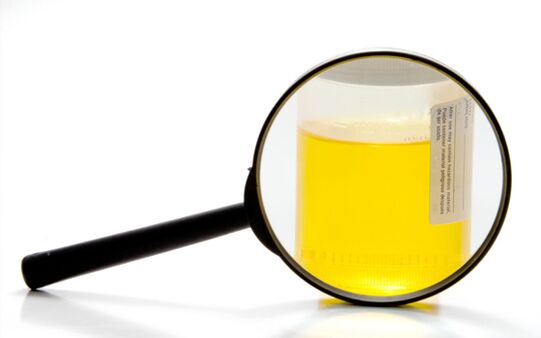 Urinalysis for the diagnosis of schistosomiasis