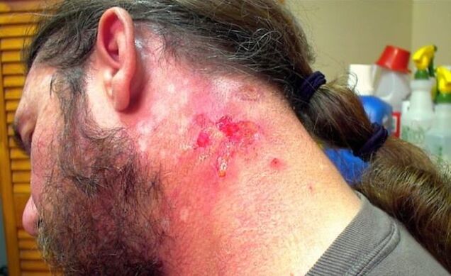Bleeding wound in the neck with Morgellons virus