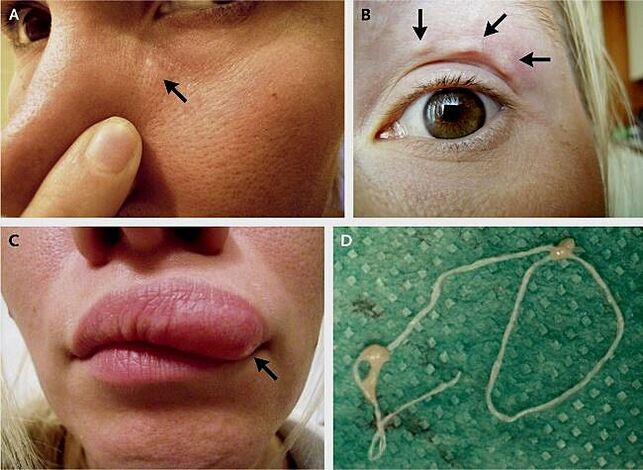 The main manifestations of dirofilariasis on the face